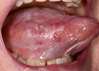 Oral Cancer Screening