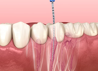 Root Canal