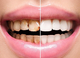 Scaling & Tooth Whitening